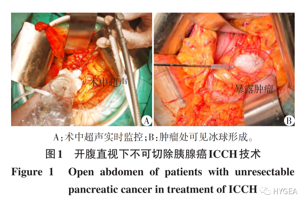 【科研資訊】術中冷凍消融和冷熱復合消融治療不可切除胰腺癌的臨床研究